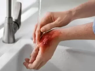 Điềm báo mơ thấy bị bỏng